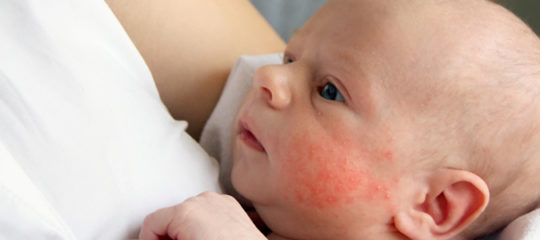 prévenir l’eczéma de bébé